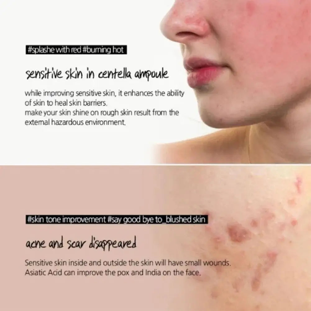 Toner Bottle Facial Ampoule Oil Control Remove Acne