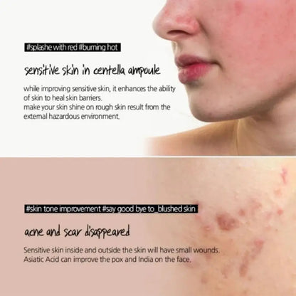 Toner Bottle Facial Ampoule Oil Control Remove Acne