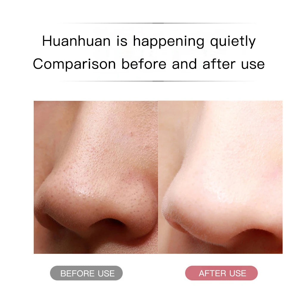 Ultrasonic Skin Scrubber Ance Pore Cleaner