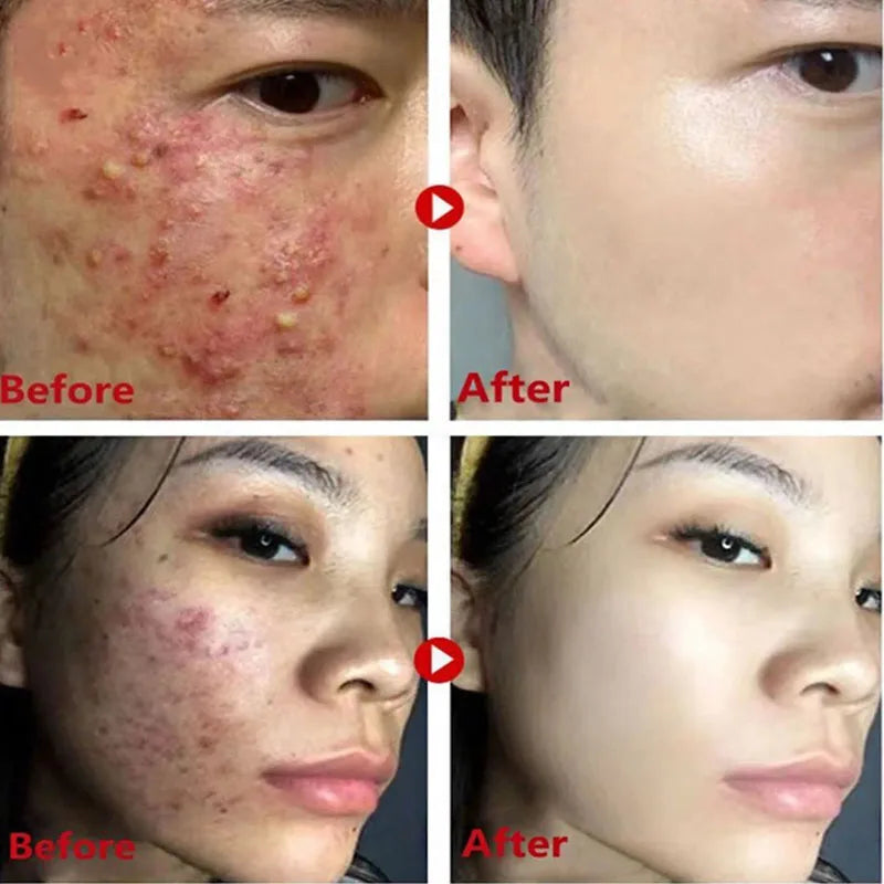 Facial Remove Blackhead Solid Mask