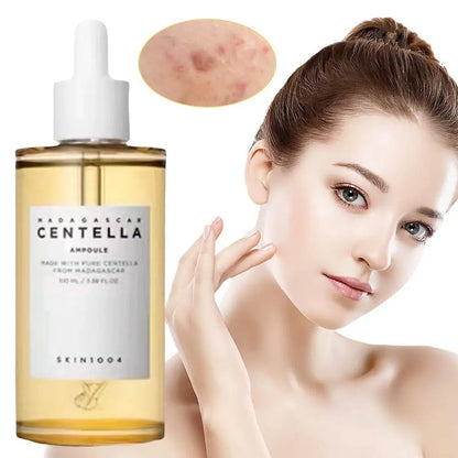 Toner Bottle Facial Ampoule Oil Control Remove Acne